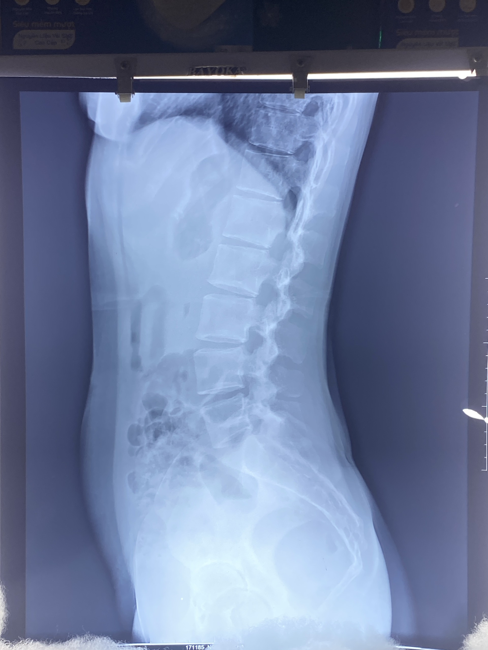 Chẩn đoán đau thắt co liên sườn tại LCC Chiropractic