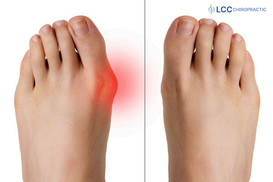 Triệu chứng di lệch xương ngón cái
