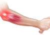 Tennis Elbow