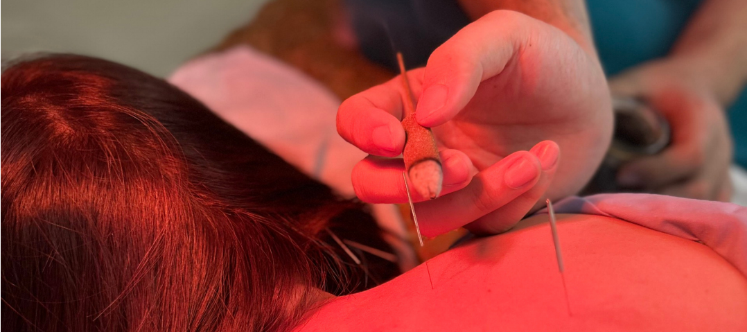 Châm cứu tại LCC Chiropractic
